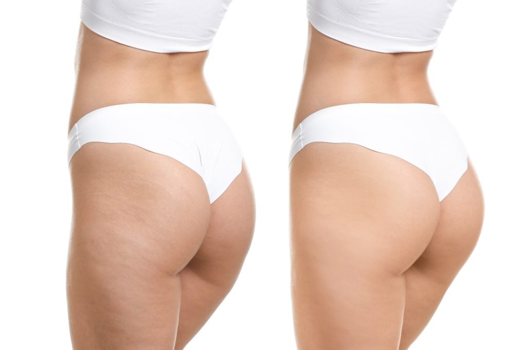 classificazione cellulite