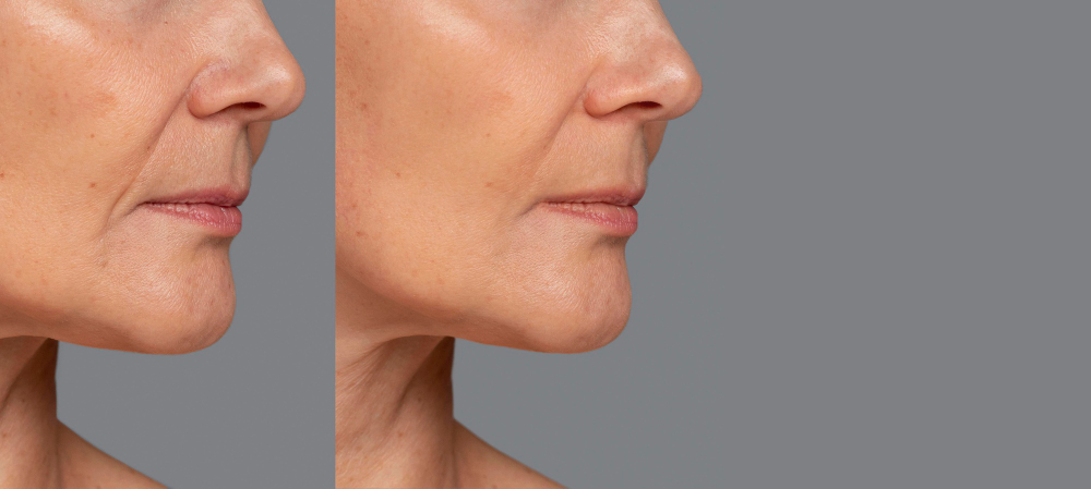 trattamenti di laser resurfacing a firenze con la dottoressa ghezzi